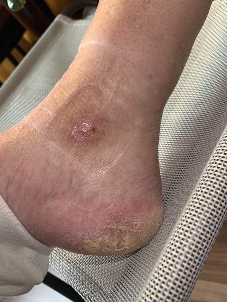 Nahezu vollständig abgeheiltes Unterschenkelgeschwür