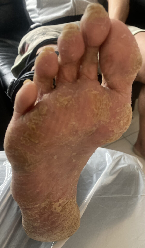 Stark verhornter Hautareale auf der Fußsohle eines mit Immuntherapie, Pembrolizumab, Keytruda, behandelten Blasenkarzinompatienten