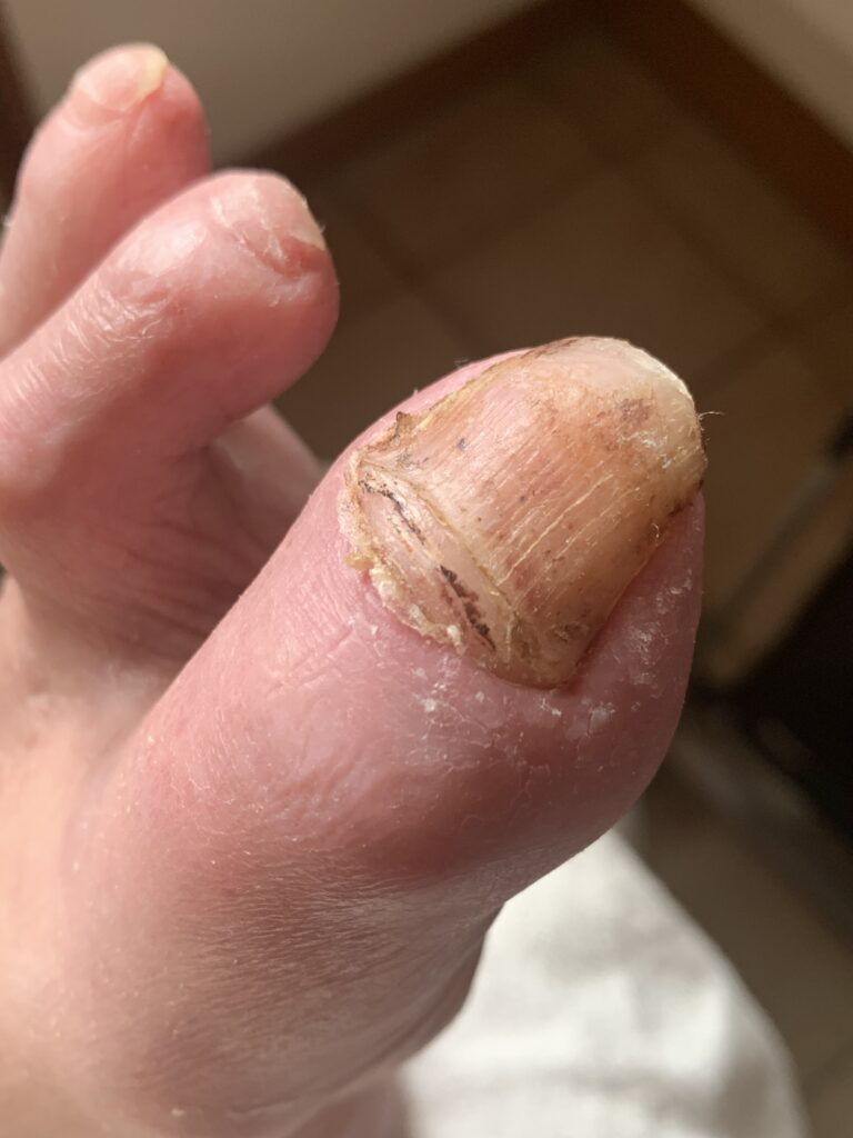 Großzehennagel bei Patient mit pAVK mit Gefäßverschluß im linken Bein