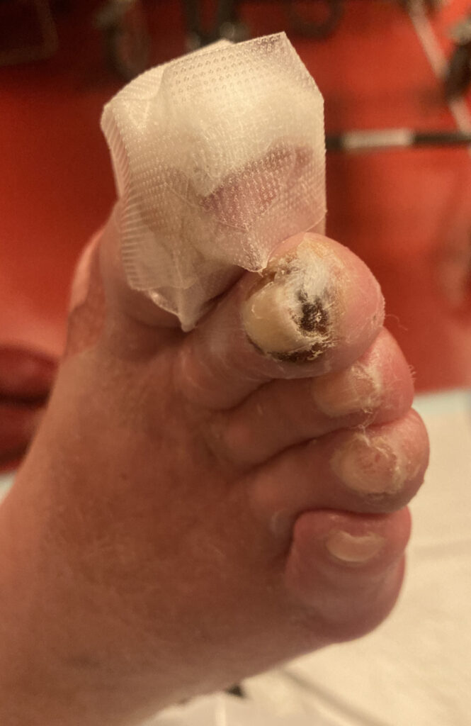 Mit steriler Mullkompresse verbundene Großzehe bei Sklerodermie