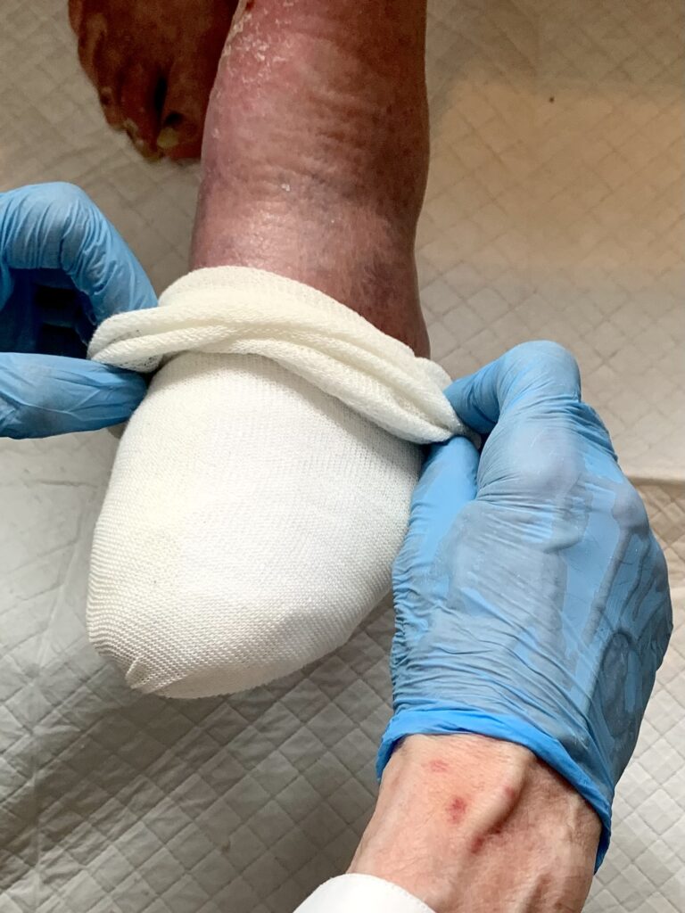 Abnahme des Schlauchverbandes vor der medizinischen Fußpflege bei offener Wunde am linken Fuß