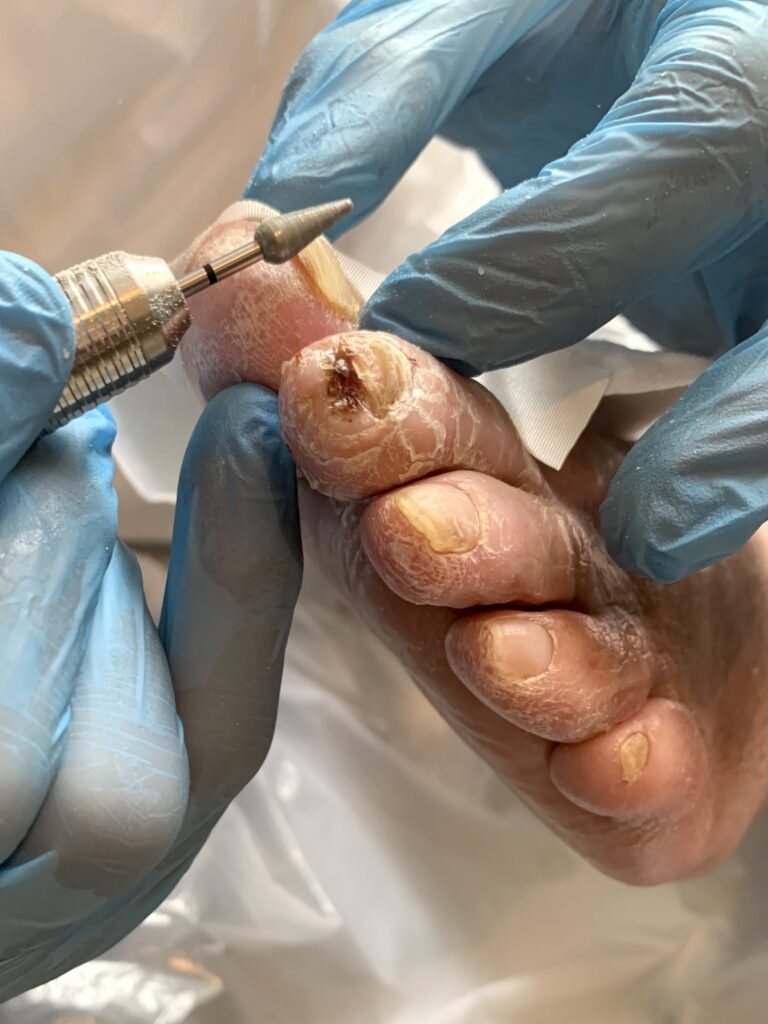 Kürzen der Zehennägel mit der Elektrofeile bei abgedeckter Wunde an der seitlichen Fläche der Großzehe