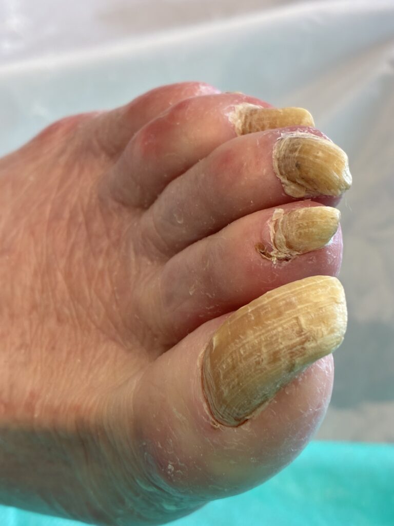 Dringend notwendige Fußpflege im Spital in Wien